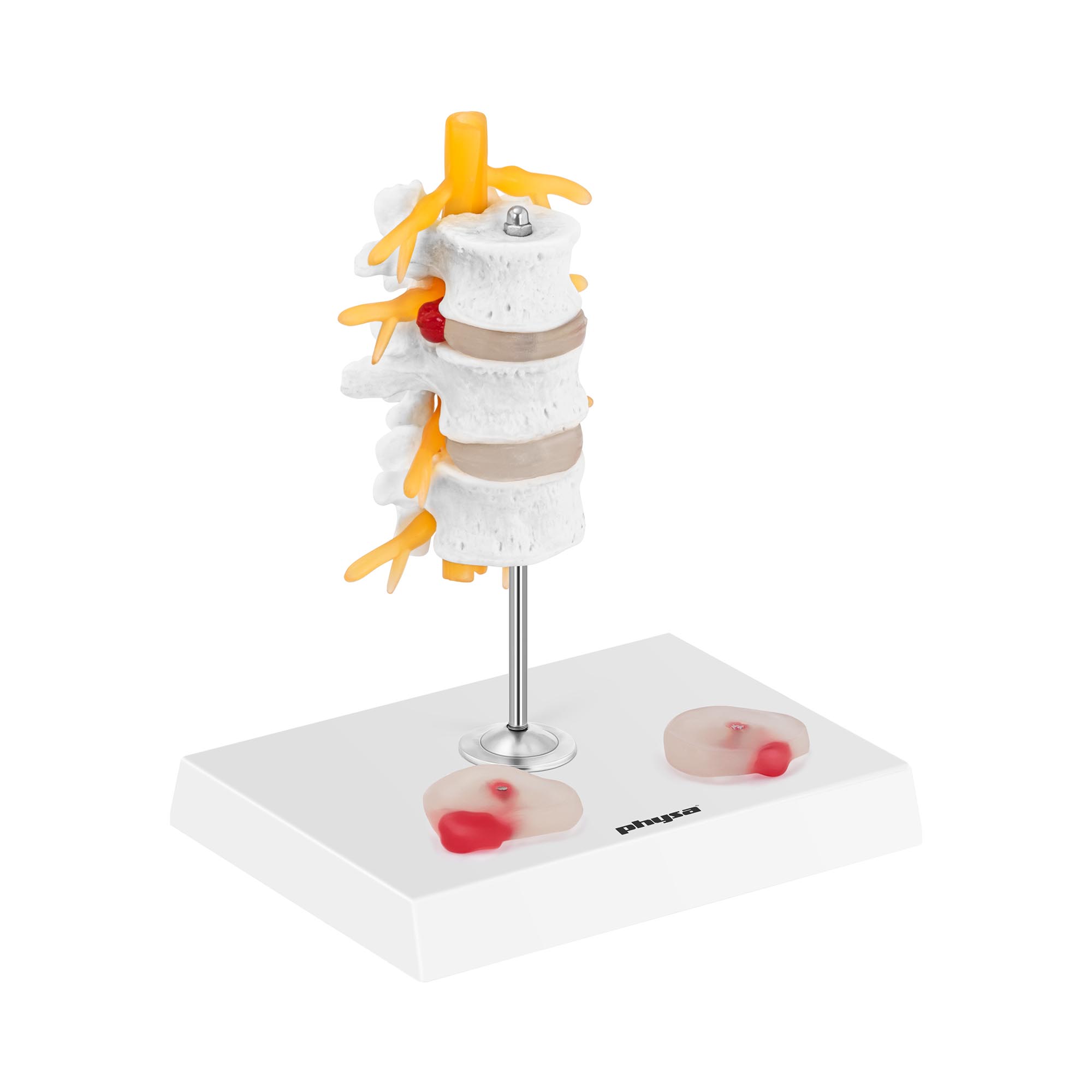 Modello anatomico ernia del disco lombare - Colorato