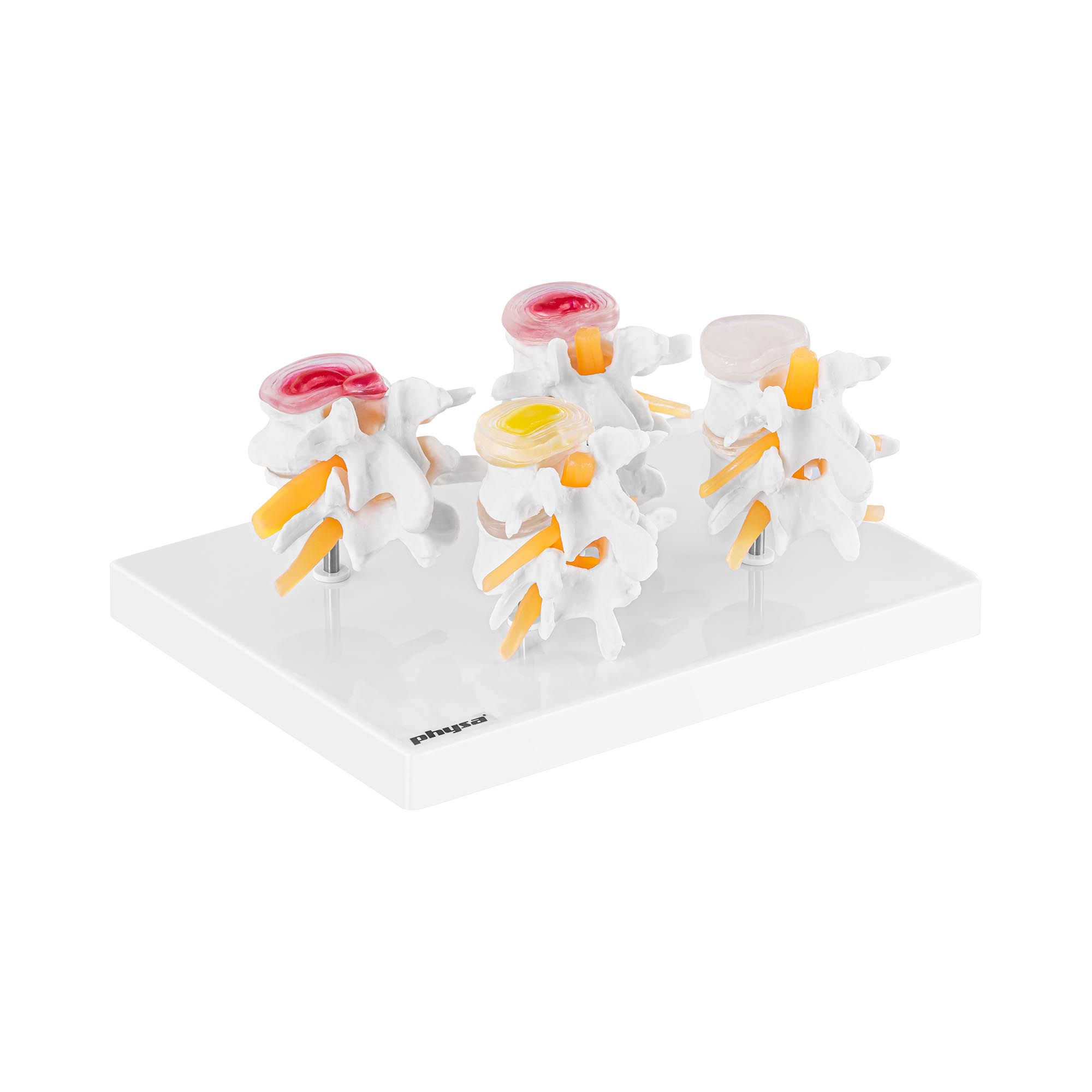 Modello anatomico degenerazione vertebrale - Smontabile in 4 parti - Colorato